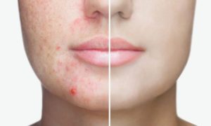 split screen of the face of a Caucasian female before and after acne treatments
