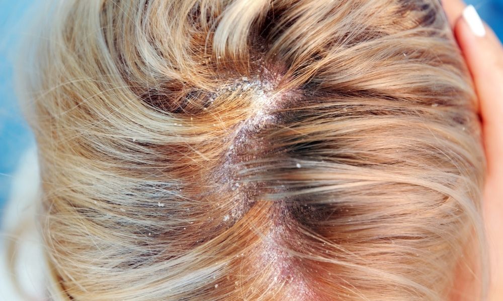 Excessive dandruff on scalp of individual