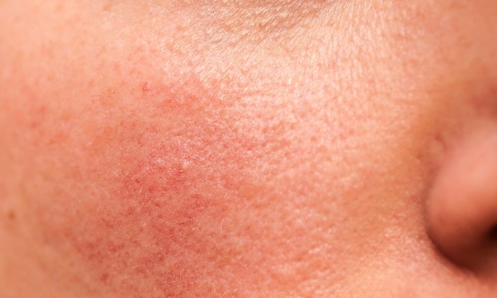Rosacea on the cheek of a caucasian male or female